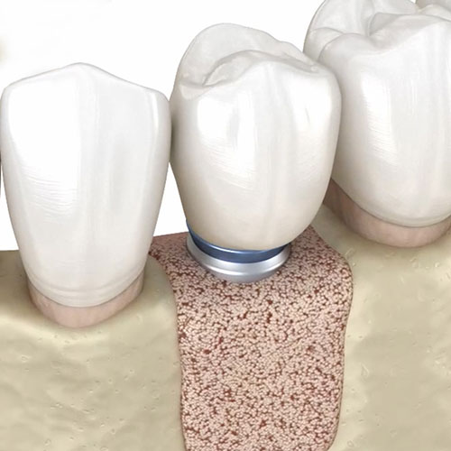 a jaw bone with bone grafting material for dental implants