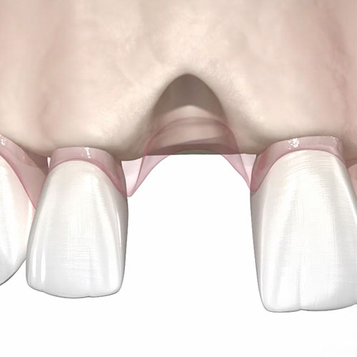 A jaw bone graphic with a missing tooth