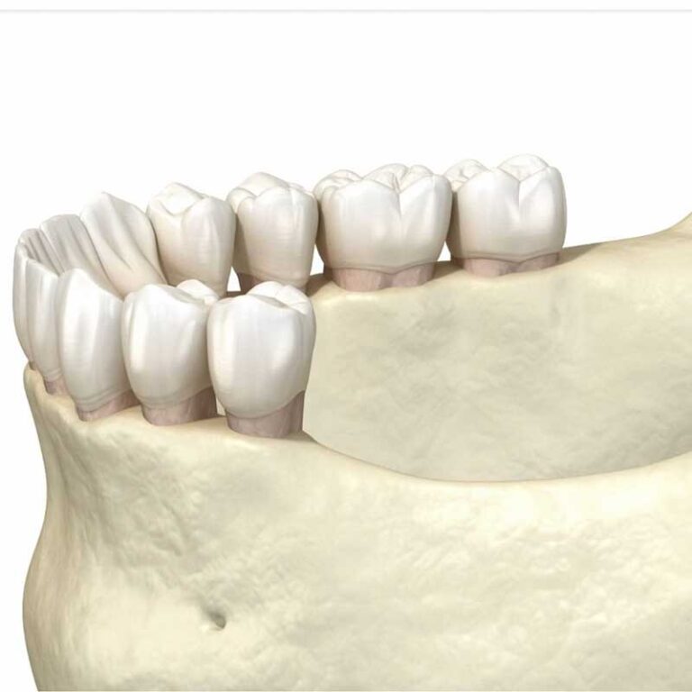 bone recession