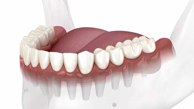 individual lower dental implants