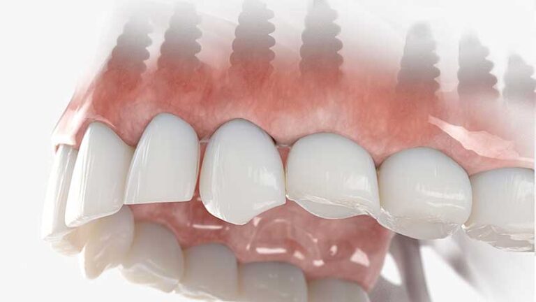 individual upper dental implants