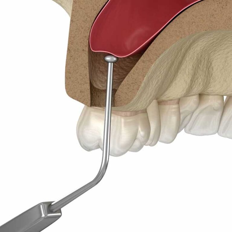 sinus lift example