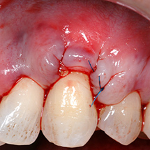 after a gum graft