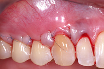 after an alloderm graft