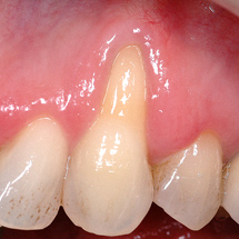 gum recession before gum grafting