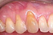 gum recession before gum grafting