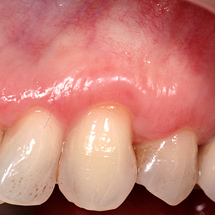 after a gum graft