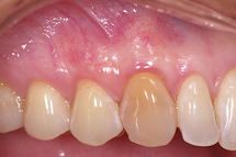 after a gum graft