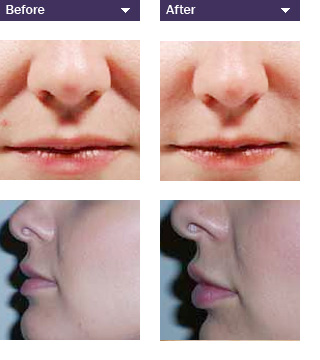 before and after example of dermal fillers