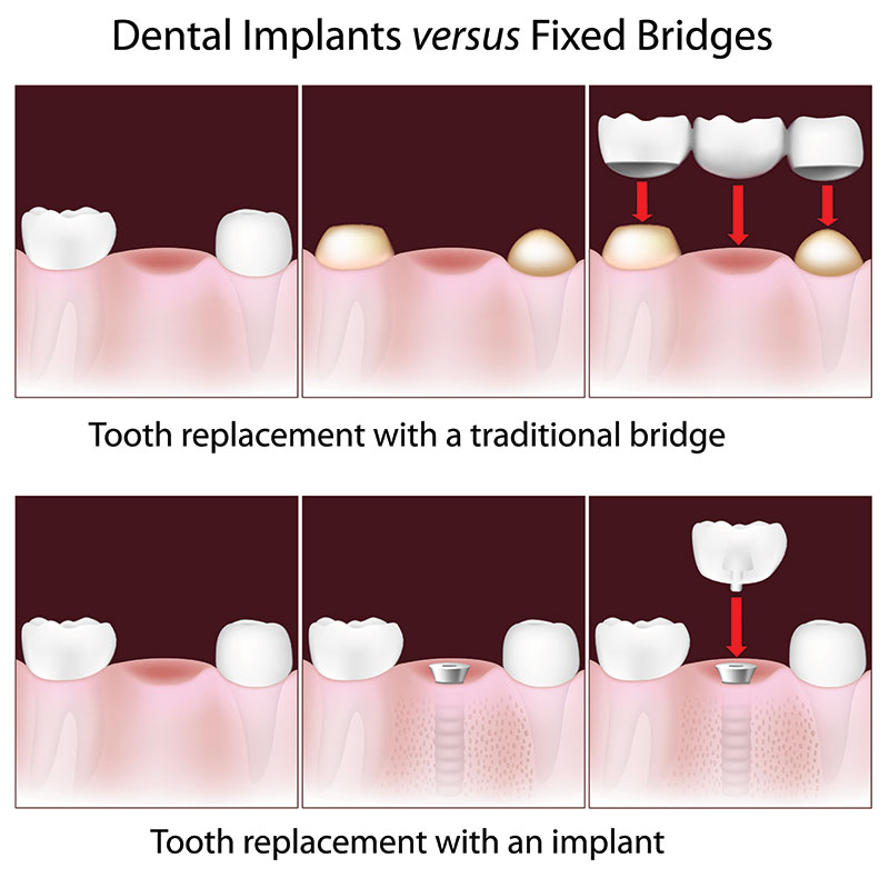 dental implant vs dental bridge drawing