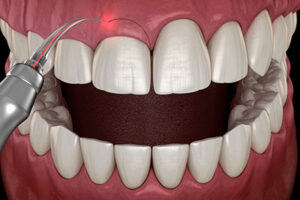 a laser being using on gum tissue