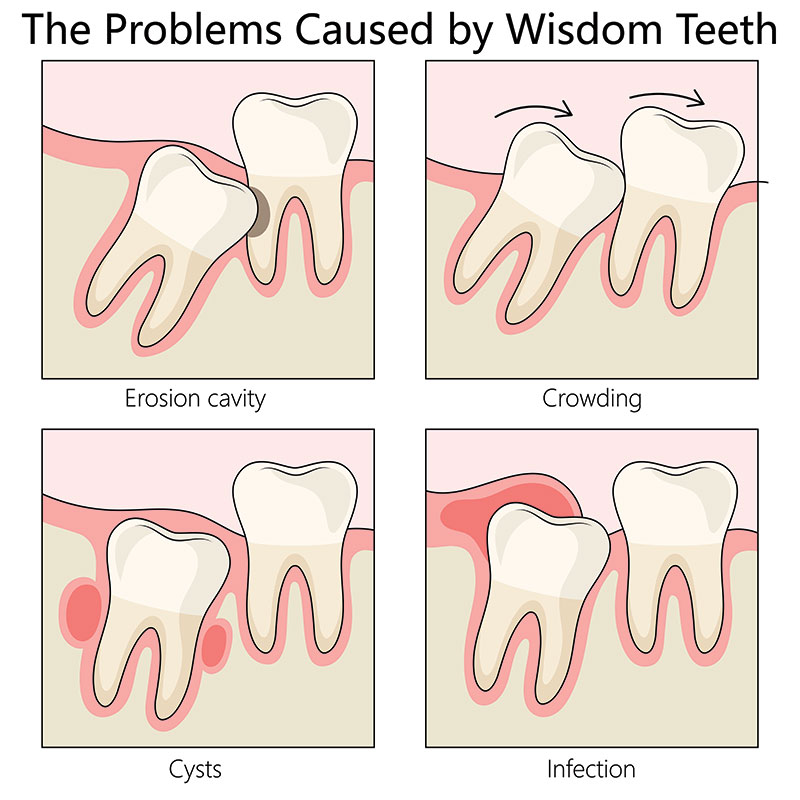 examples of wisdom teeth impaction problems